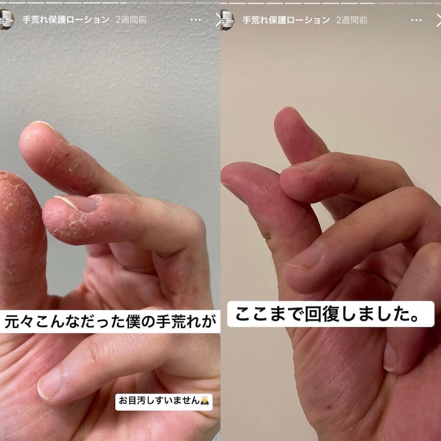 住吉さんの手は、ここまで回復