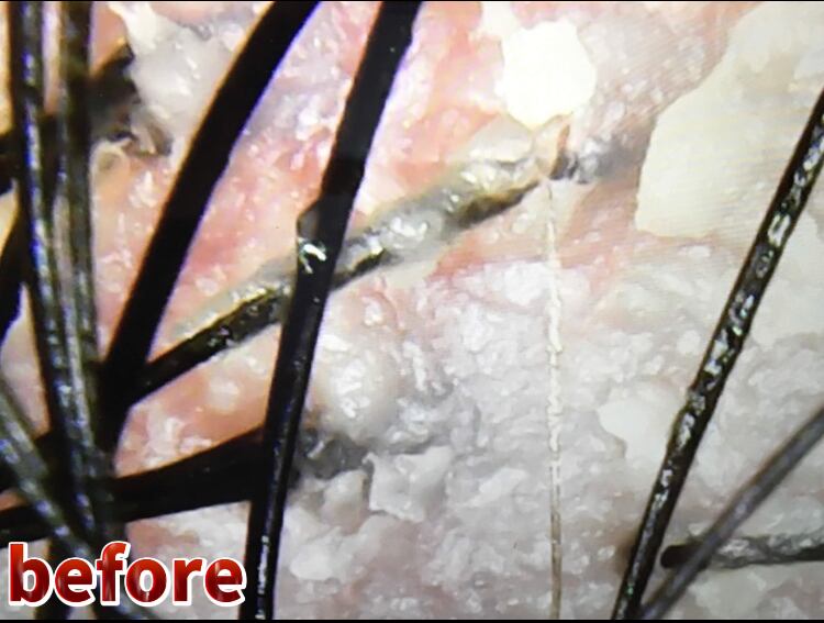 角質と酸化した皮脂で炎症しています。