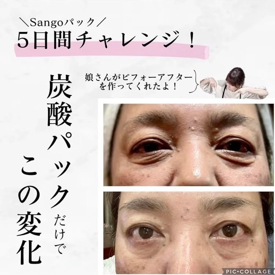 炭酸パックでここまで変わる☆