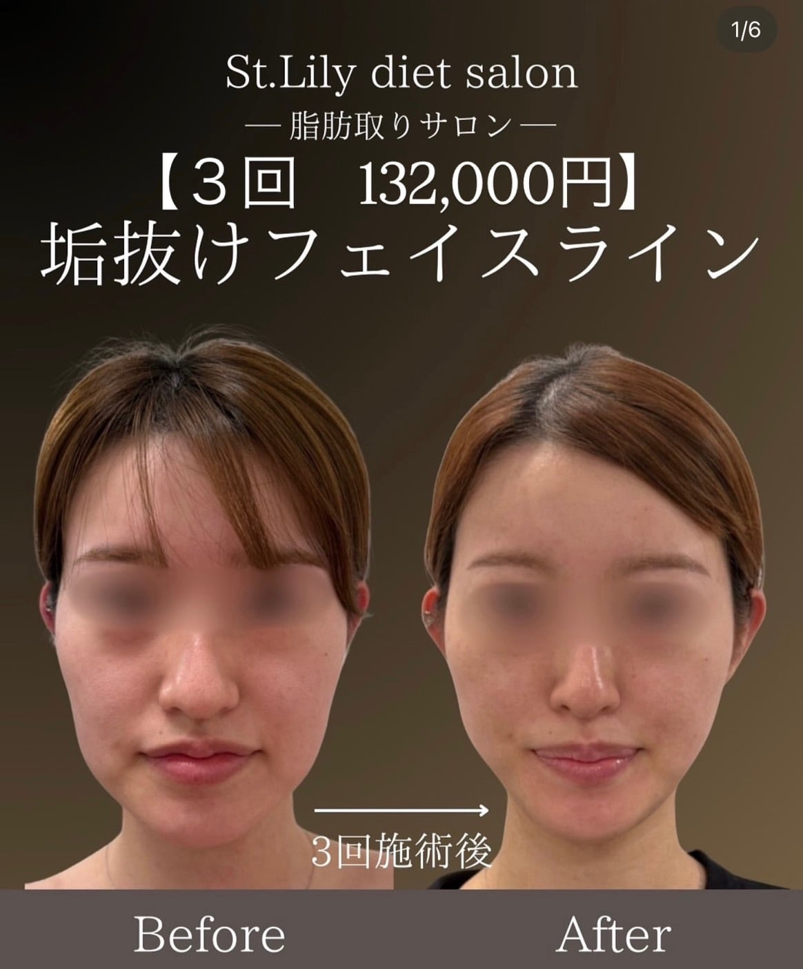 st.Lily メソセルダイエットキット 美容液付き St.Lily ダイエットキット 【公式通販】
