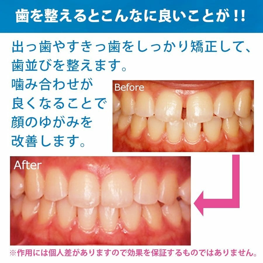 2個！マウスピース 保護 歯列矯正 歯ぎしり  いびき ソフト ハード