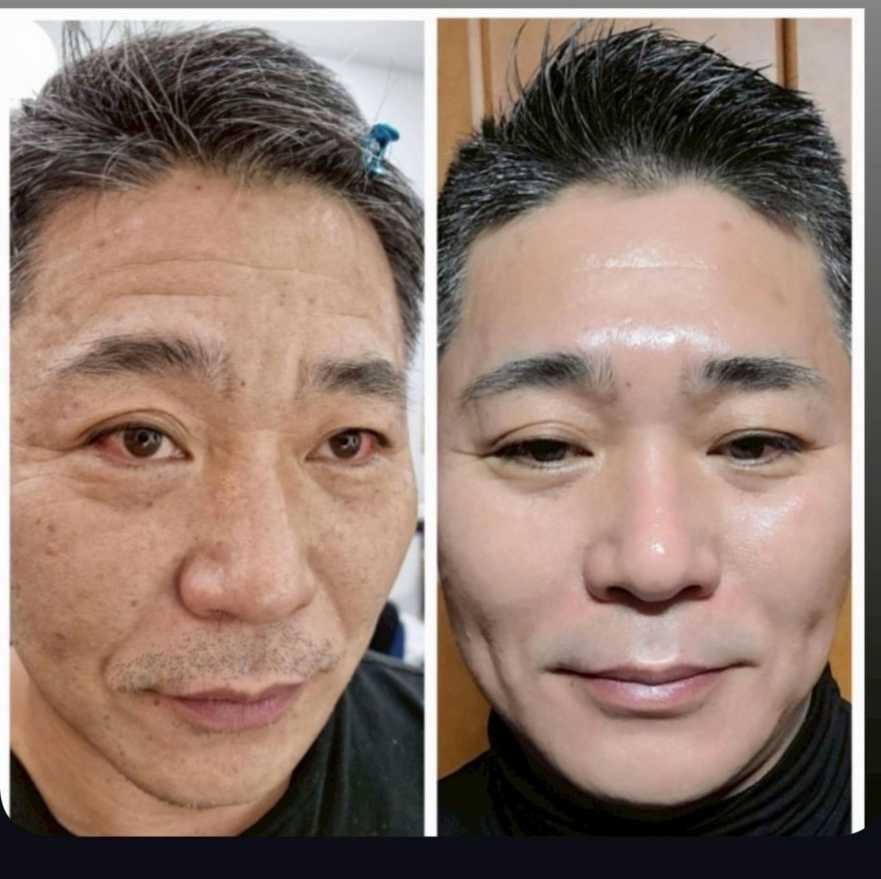 インセルダム症例写真 | incellderm-ICD-整形級コスメインセルダム