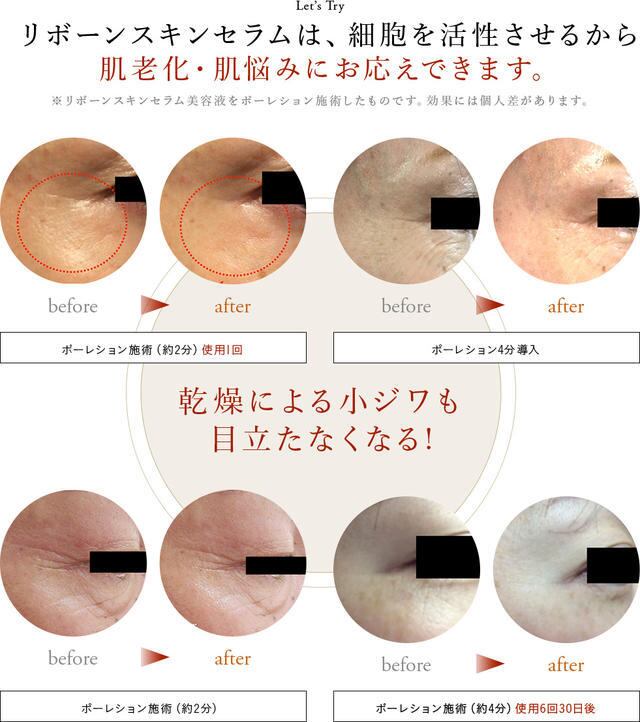 Reborn skin Serum】 リボーンスキンセラム（ヒト脂肪幹細胞高配合美容