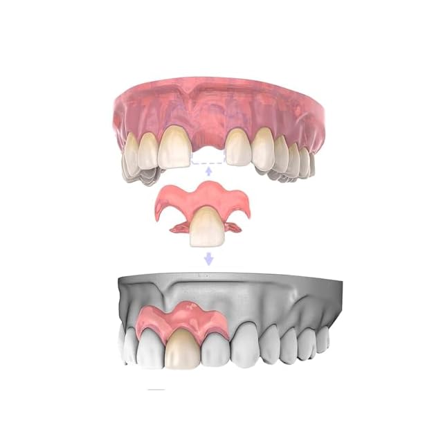 1本 カスタム 入れ歯 部分 取り外し可能 Dentellea 義歯 携帯便利 自然