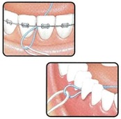 【サンスター/バトラー】【歯科用】フロススレッダー #840P 1袋5本入【フロス挿入補助用品】