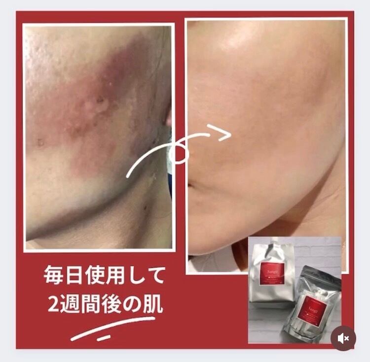 正規販売店】Sango（サンゴ）炭酸パック 5回分｜おうちでエステ級の