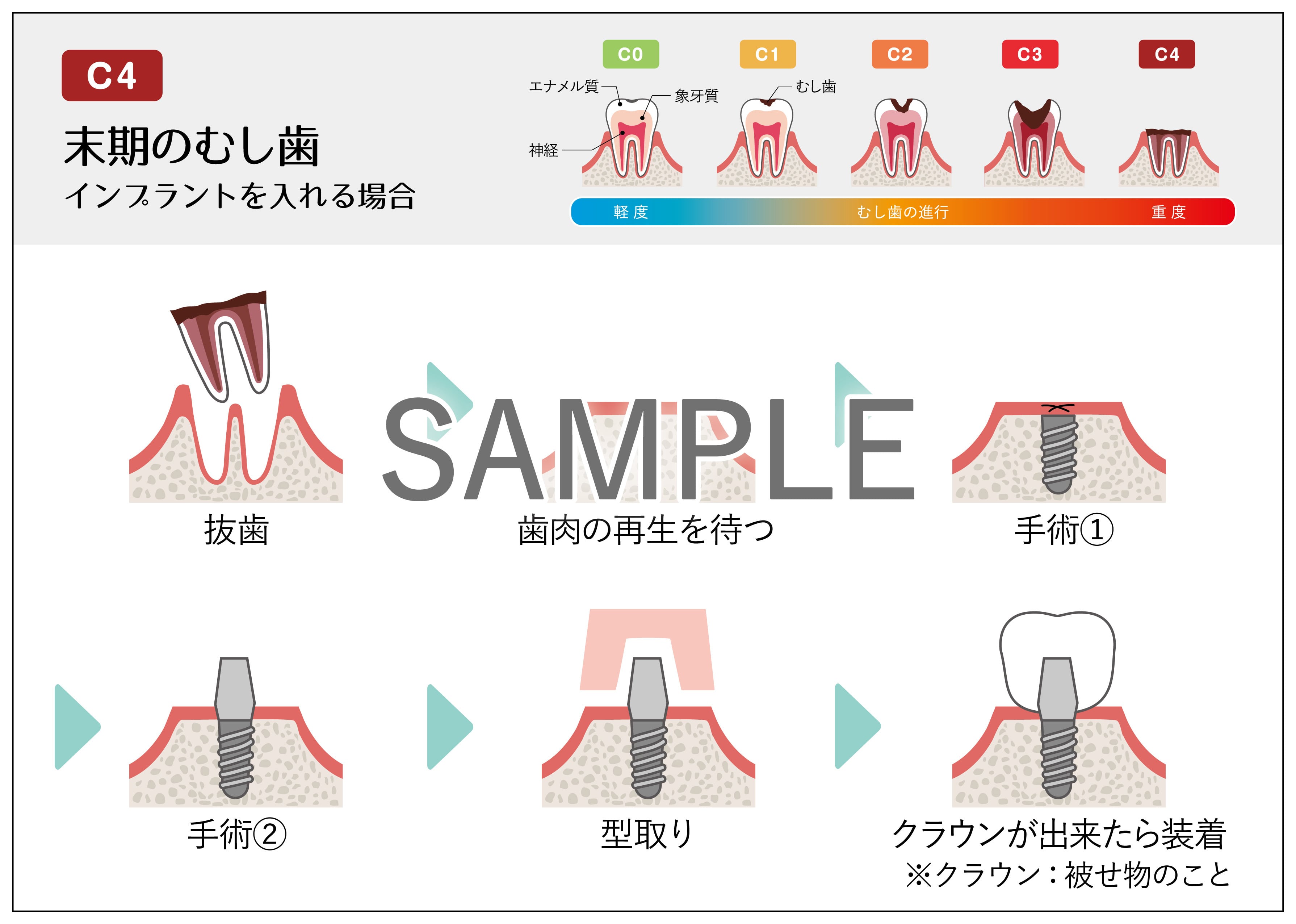 データ販売】むし歯治療セット | 歯科グッ！とぷりんと