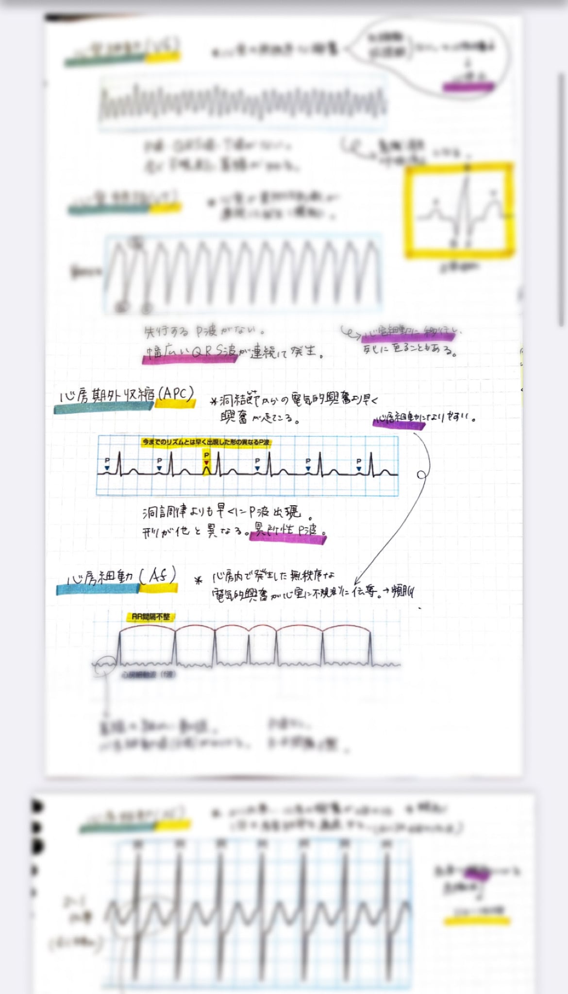 心電図モニター異常波形カンペ | czynotebook