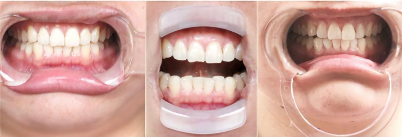 ホワイトニングオープナー 匿名配送セルフホワイトニング用マウス