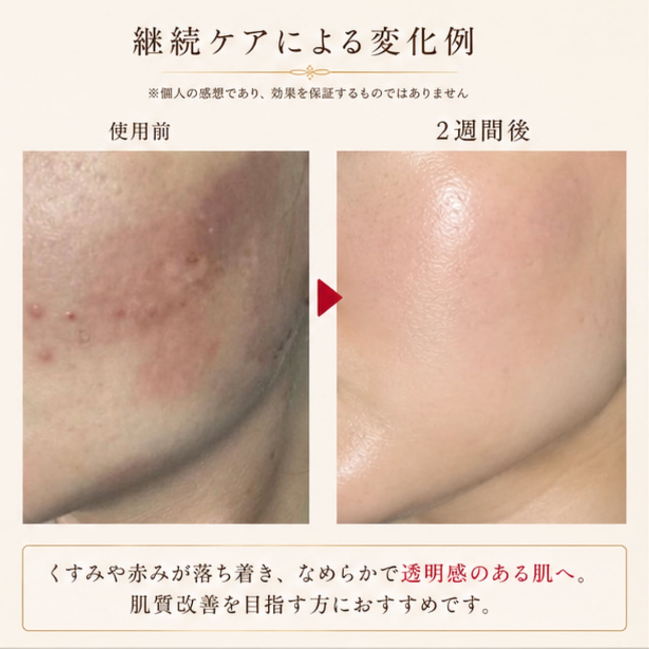 おうちで本格肌質改善】Sango 炭酸パック（30回分）※ 計量カップ