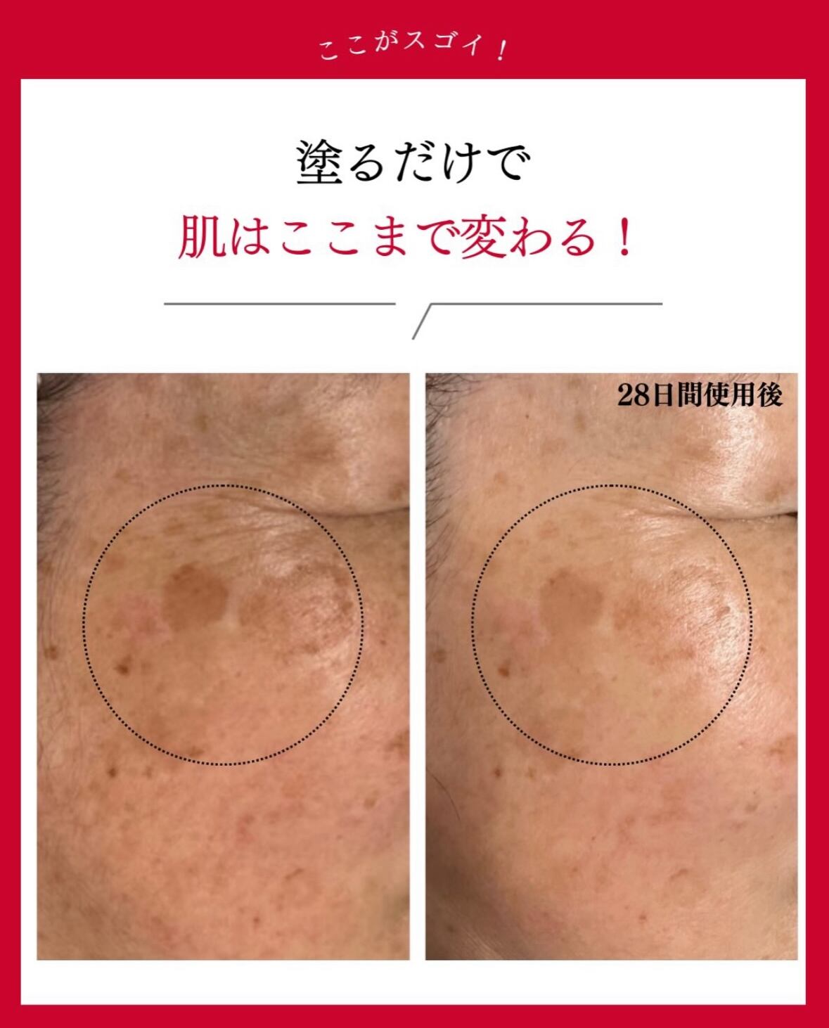 Acnetin A Cream（アクネチンa） 0.05% 10g 2個 | PAY ID