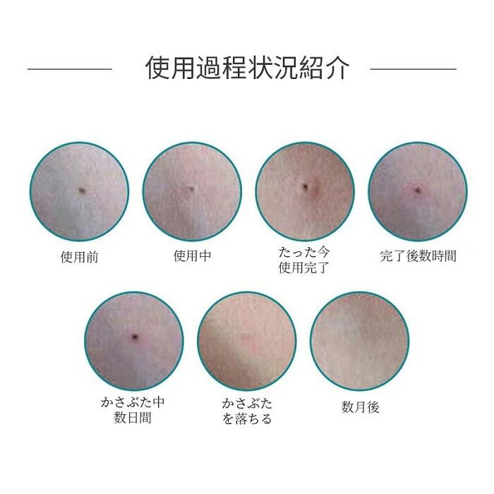 そばかす ほくろ レーザーペン除去 タトゥー いれずみ除去ペン