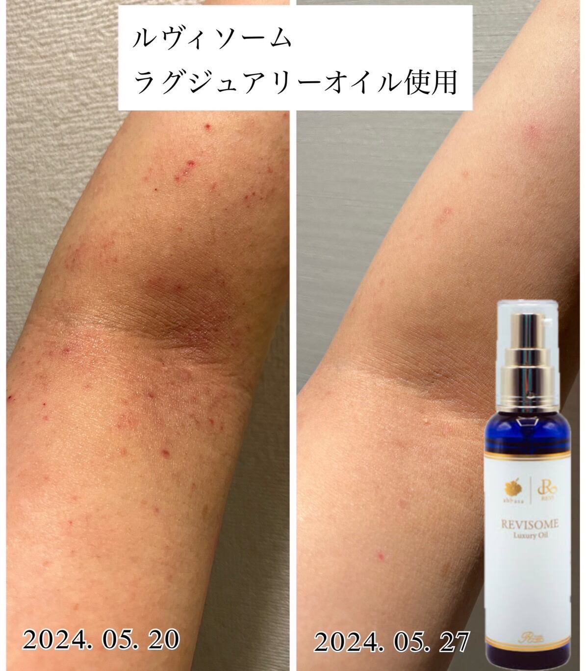 REVI ルヴィソームラグジュアリーオイル ミニサイズ 50ml タマヌオイル