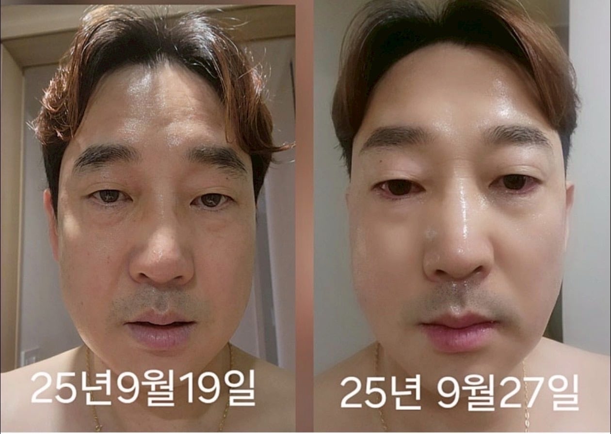 インセルダム症例写真 | incellderm-ICD-整形級コスメインセルダム