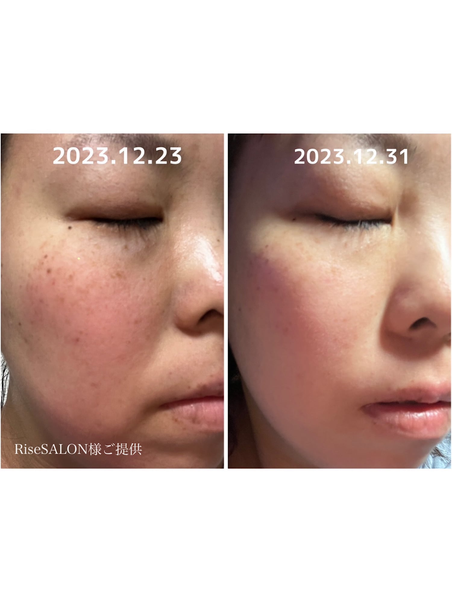 注入するCysay因子】ダーマショットセラム 400shot | ECXIA online shop.