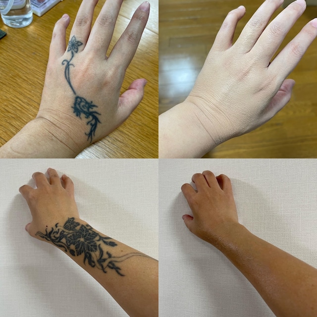 自分であざ・刺青・TATTOO隠したい方（アートメイク講座）