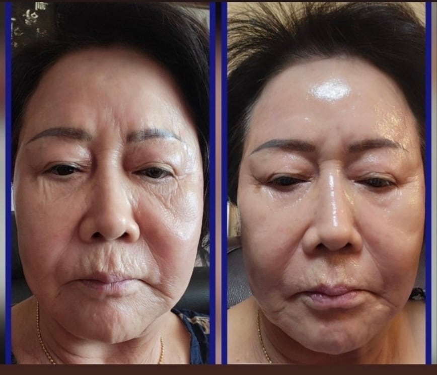 インセルダム症例写真 | incellderm-ICD-整形級コスメインセルダム