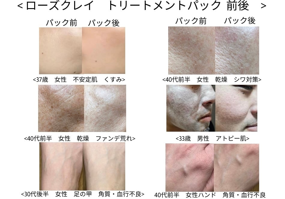 Roseclay Treatment Pack ローズクレイ トリートメント パック