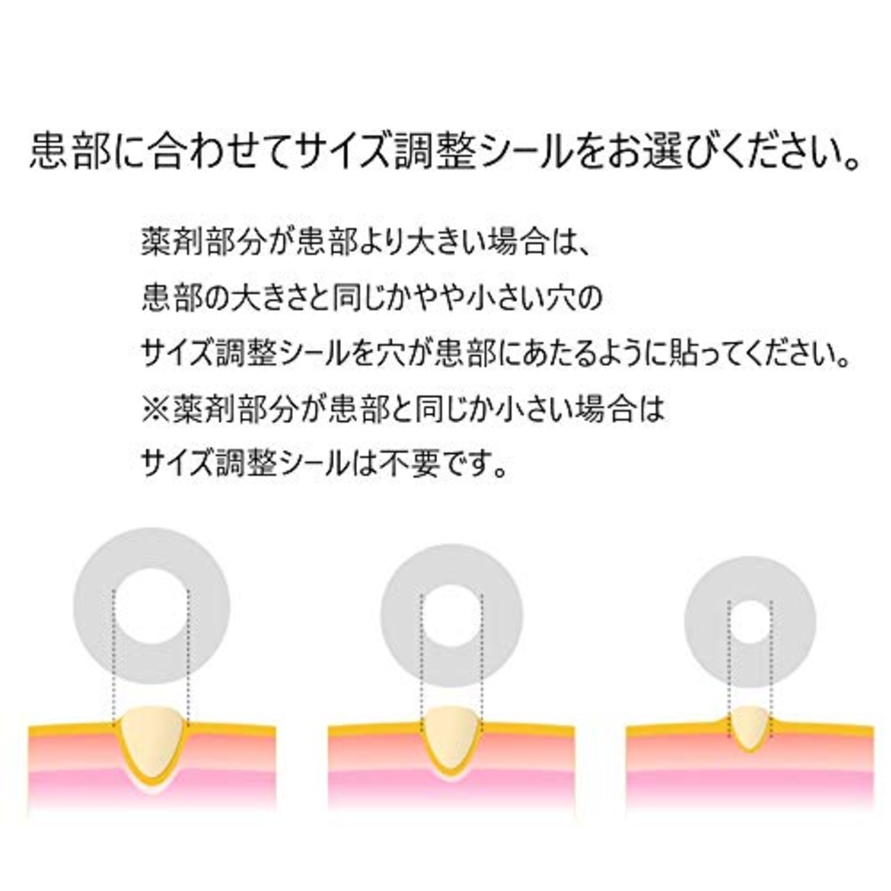 ニチバン フットケア スピール膏CX うおのめ・たこピンポント除去タイプ 直径10mm SPCXN