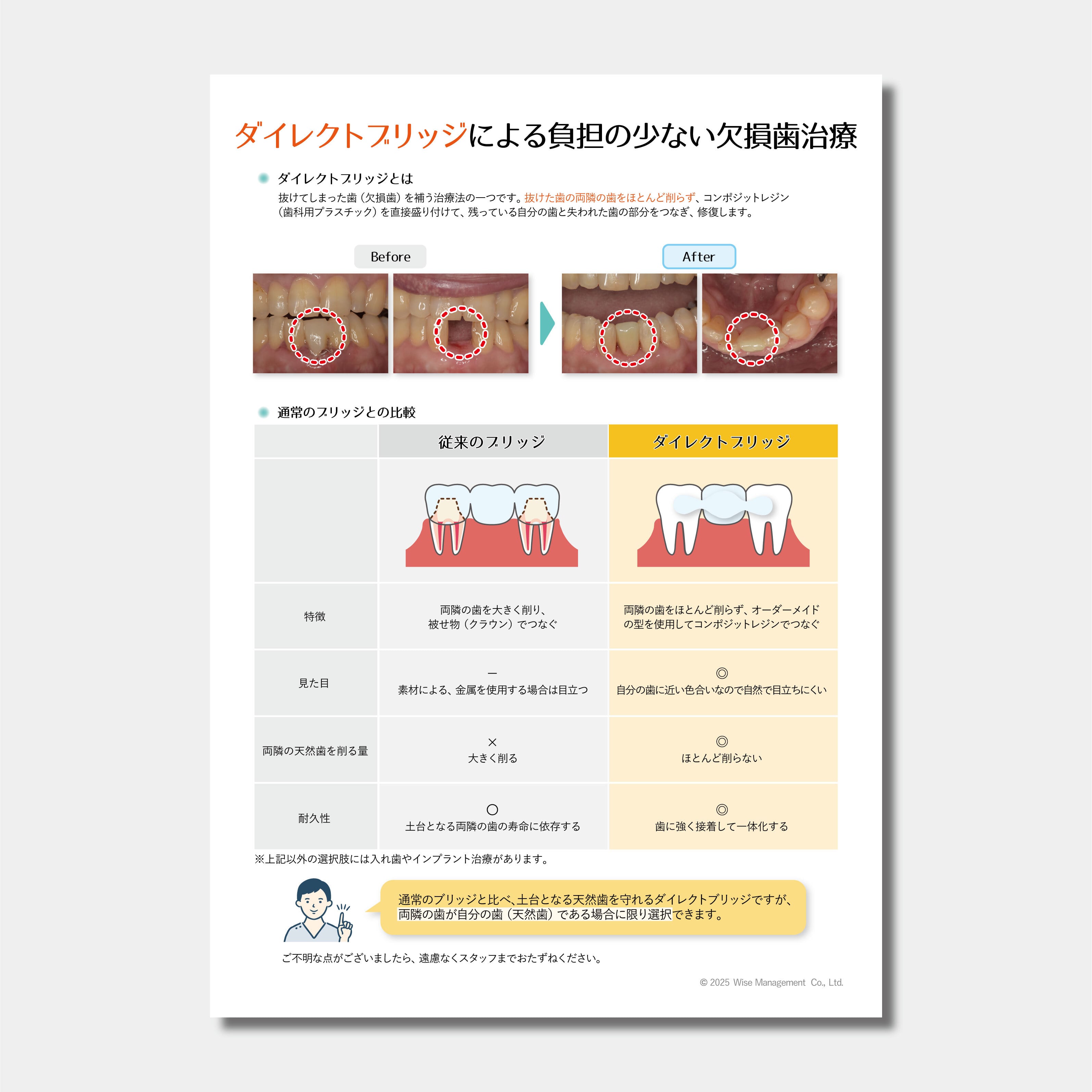 【データ販売】ダイレクトブリッジによる負担の少ない欠損歯治療
