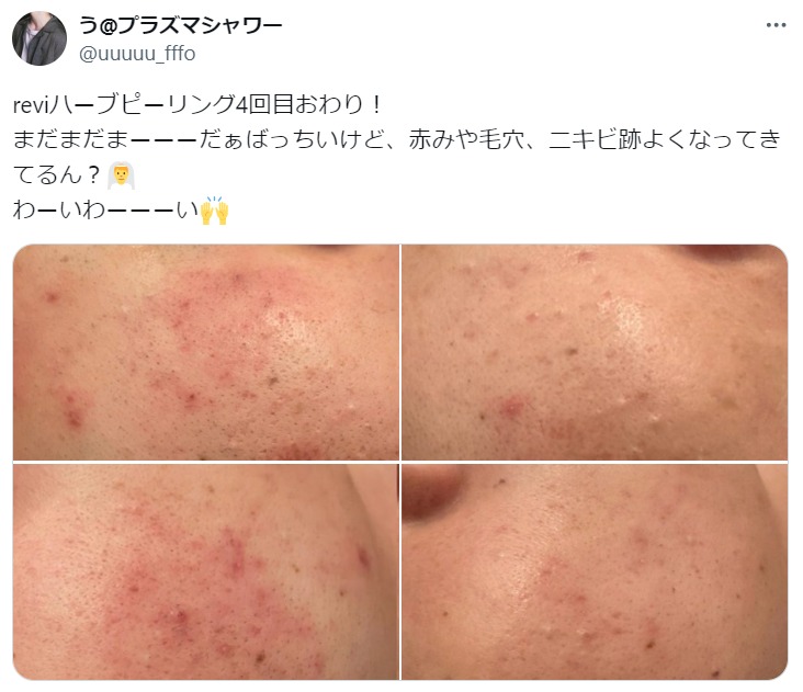 REVI(ルヴィ)ハーブピーリングの効果とは？効果なしと言われる
