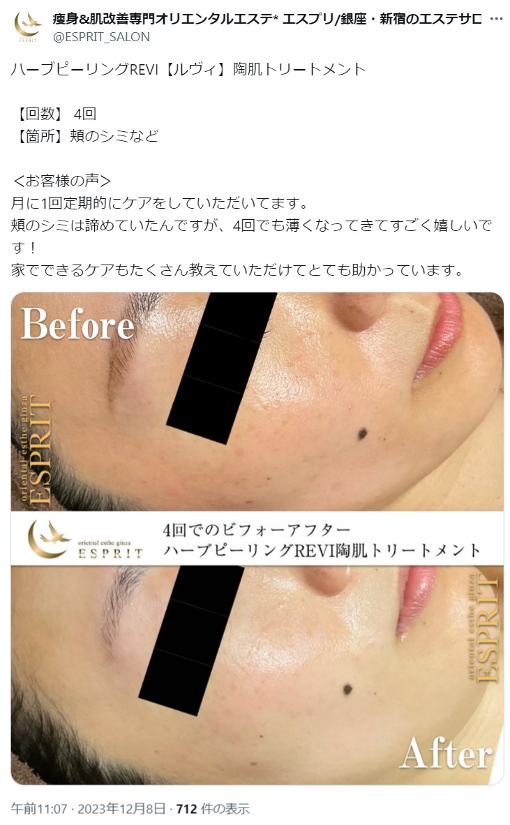 お気に入りの REVI(ルヴィ)ハーブピーリングの効果とは？効果なしと言われる トライアルセット・サンプル