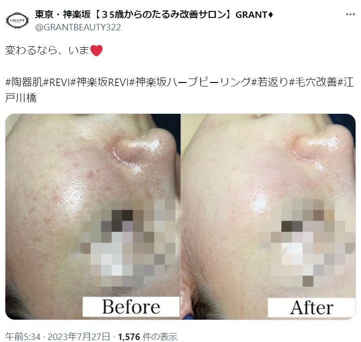 REVI(ルヴィ)ハーブピーリングの効果とは？効果なしと言われる