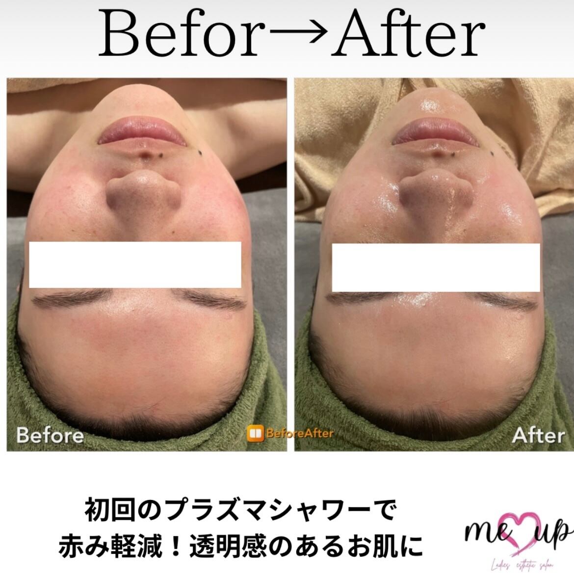 ラヴィ プラズマシャワー 透明感のあるお肌に☆プラズマシャワー | REVI MEUP ルヴィ正規販売会社